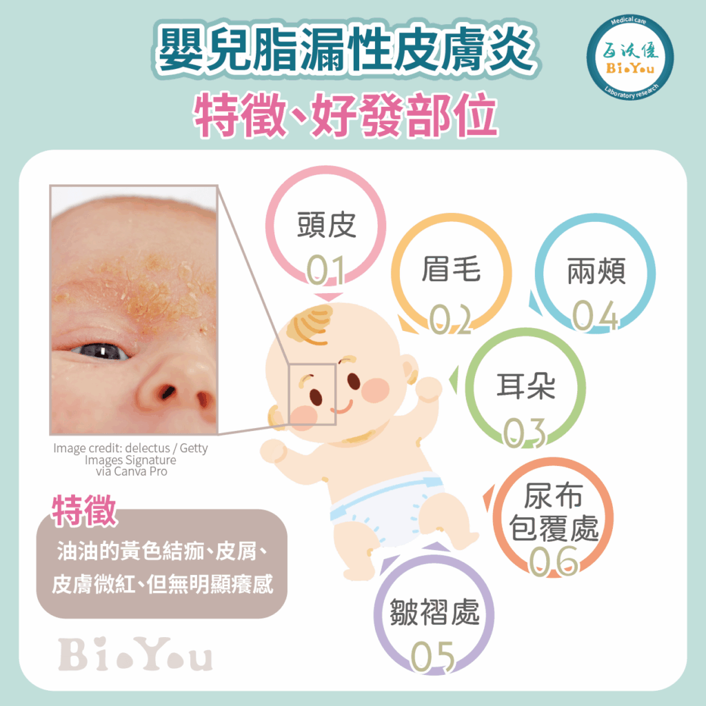嬰兒脂漏性皮膚炎特徵及好發部位