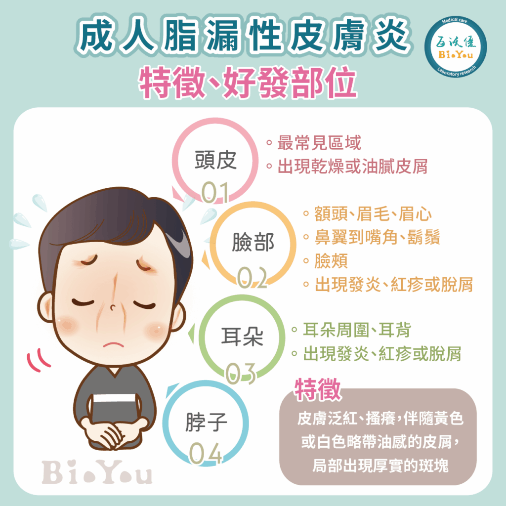脂漏性皮膚炎的特徵及好發部位
