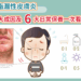 脂漏性皮膚炎的7大成因及6大照護方法