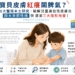 季節性異位性皮膚炎首圖
